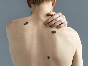 Several prominent pigmented lesions on the back, reflecting the skin changes that warrant careful medical attention