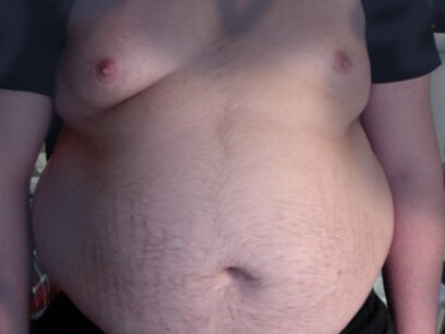 De 1990 a 2022, las tasas mundiales de diabetes se duplicaron en hombres (del 6,8 % en 1990 al 14,3 % en 2022). Adolescente obeso,16 años, peso 136 kg
