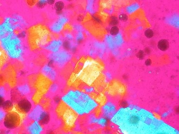 Cristalli di colesterolo nel liquido sinoviale (polariscopia compensata). Immagini patologiche e istologiche di Ed Uthman
