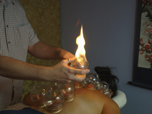 Cupping therapy