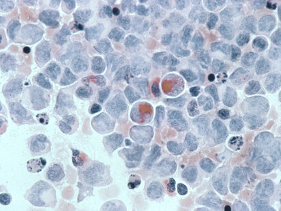 Long-term electromagnetic exposure to microwave radiation is associated with cancer (here leukaemia)