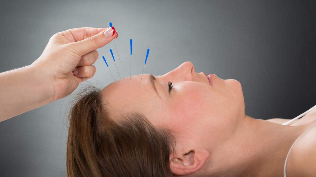 Acupuncture offers treatment for headaches and migraines