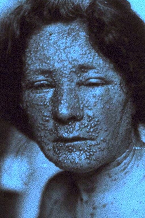 Mujer infectada de viruela