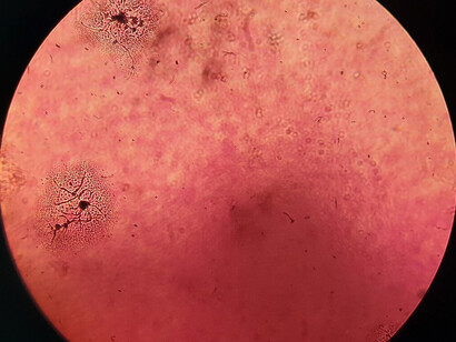 Pseudomonas aeruginosa. En pacientes con fibrosis quística, los fagos han resultado efectivos contra Pseudomonas aeruginosa, mejorando la calidad de vida sin comprometer la función pulmonar