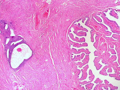 Es una enfermedad que padecen entre un diez y un quince por ciento de las mujeres. Es más habitual de lo que parece y la puede sufrir cualquiera de nosotras. Endometriosis en la pared de la trompa de Falopi