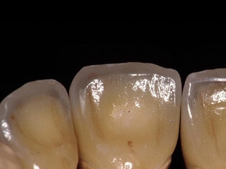 Corone in ceramica integrale zircon free