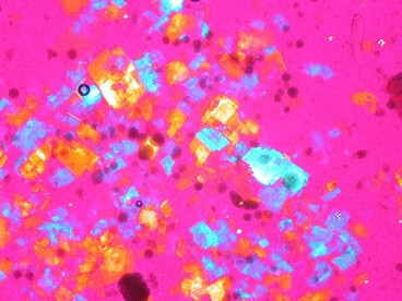 Cristalli di colesterolo nel liquido sinoviale (polariscopia compensata). Immagini patologiche e istologiche di Ed Uthman