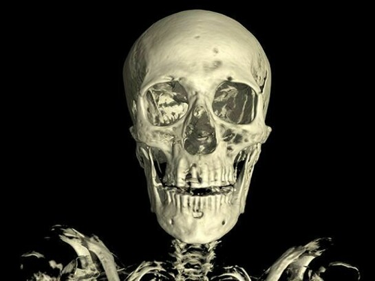 Linenman skull. The CT scan of the skull of the mummy of an adult man (name unknown). The scan shows considerable evidence of dental abbcesses and the loss of several teeth. © Trustees of the British Museum