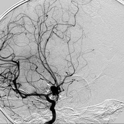 Angiografía de un aneurisma cerebral