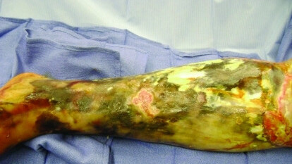 Fascitis necrotizante causada por Vibrio Vulnificus