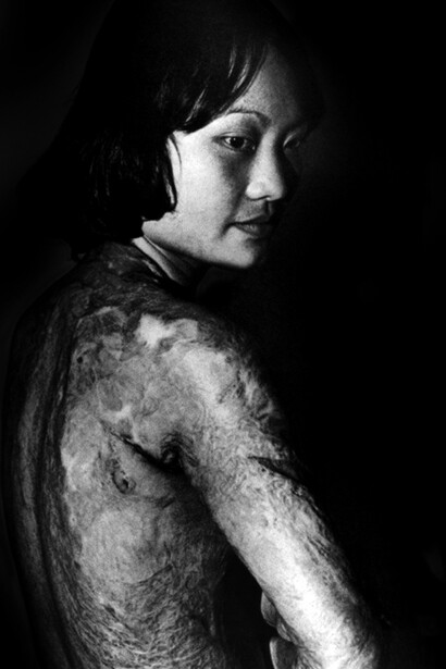 Kim Phuc, mostrando las graves quemaduras en su espalda y brazos. Cortesía: Rubén Darío Arenas