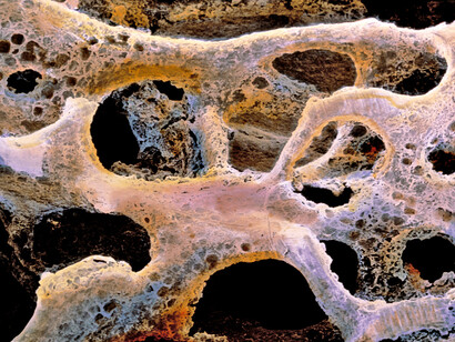 Osteoporosi
