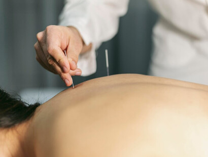 The acupuncture process, a key aspect of traditional healing methods in alternative medicine