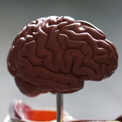 Cervello. La demenza è una condizione neurologica caratterizzata da un declino di molteplici funzioni cognitive