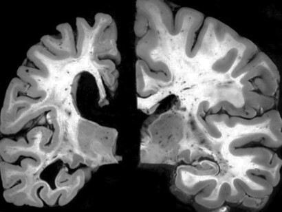 Cabe pensar que el SARS-CoV-2 no es un virus puramente respiratorio y el sistema nervioso juega un papel no solamente pasivo en la infección, sino que contribuye a la respuesta sistémica observada en el COVID-19