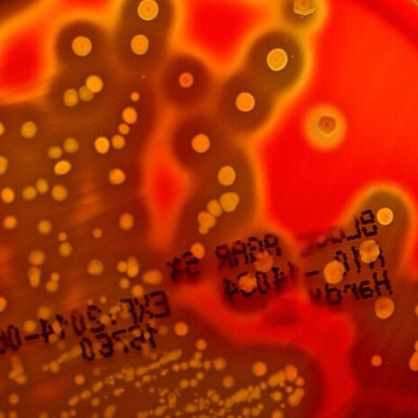 «Streptococcus pyogenes», agente patógeno tras la corea de Sydenham