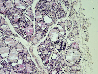 Las hormonas tiroideas son esenciales para el crecimiento, y esto incluye al bebé que está creciendo en tu barriga. Sección transversal, aumento: 40×, tinción con hematoxilina y eosina. Estructura folicular de la glándula tiroides humana