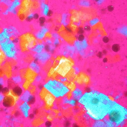 Cristalli di colesterolo nel liquido sinoviale (polariscopia compensata). Immagini patologiche e istologiche di Ed Uthman
