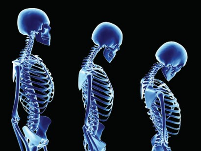 El deterioro del esqueleto humano