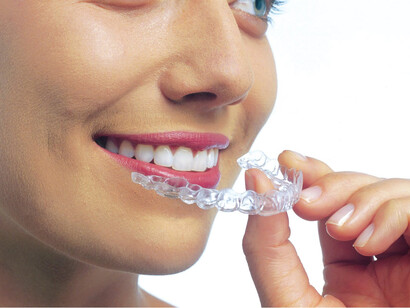 Il bite odontoiatrico agisce sui problemi di malocclusione
