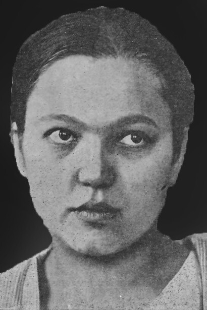 Rostro hipoplásico infantil. Perfil que se inclina hacia abajo en línea recta. Nariz poco desarrollada, piel esponjosa e hinchada. Idiotez esquizofrénica grave, 19 años
