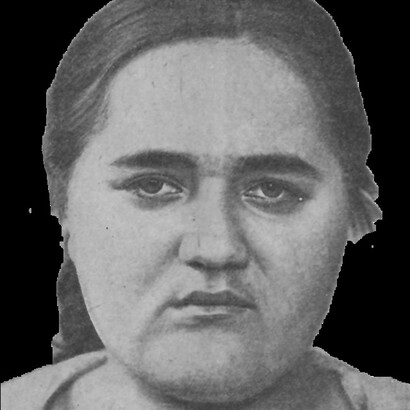 Crecimiento displásico de grasa. Debilidad mental puberal esquizofrénica a los 19 años. Hipoplasia en la parte media del rostro; desarrollo grueso y tosco de pómulos y mentón; obesidad sin forma