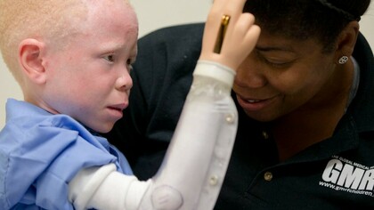 Niño albino africano con un brazo ortopédico