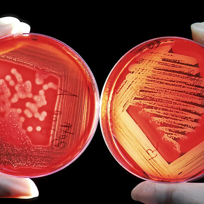 «Streptococcus pyogenes», agente patógeno tras la corea de Sydenham