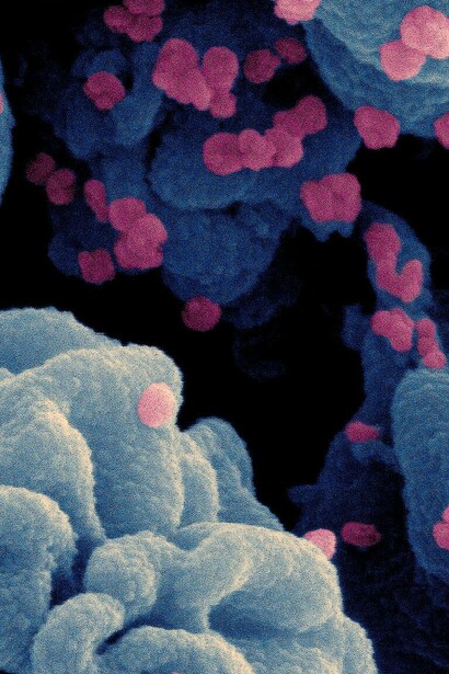 Célula infectada con partículas del virus SARS-CoV-2