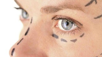 El rostro de una mujer con las marcas para realizar la cirugía plástica