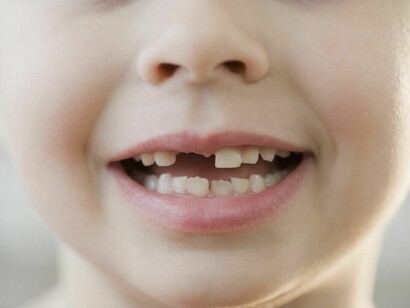 A little boy's smiling, suffering from hypodontia