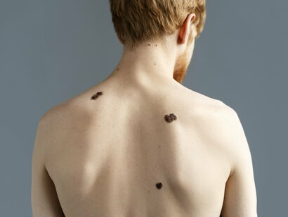 Distinctive dark spots appearing on the skin, symbolizing the importance of monitoring suspicious moles for melanoma