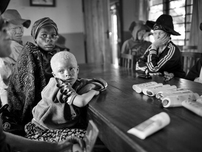 Colour discrimination against persons with albinism in South Africa