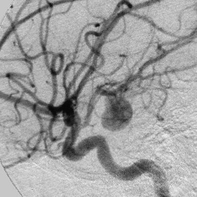 Angiografía de un aneurisma cerebral