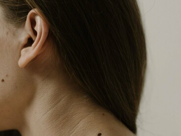 A close-up of naturally occurring moles, symbolizing the importance of becoming familiar with your skin's normal appearance