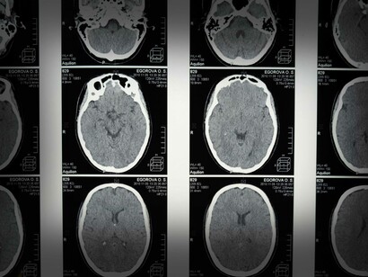 L’emisfero sinistro è detto della parola 