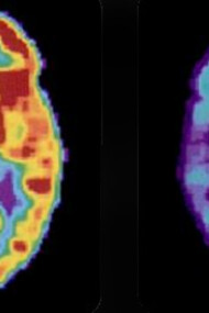 Desentrañando el misterio. Tomografías por emisión de positrones (PET) que muestran las diferencias entre el cerebro de una persona mayor sana —izquierda— y el de una persona mayor que padece la enfermedad de Alzheimer