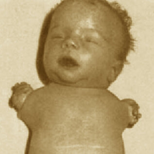 Bebé con focomelia