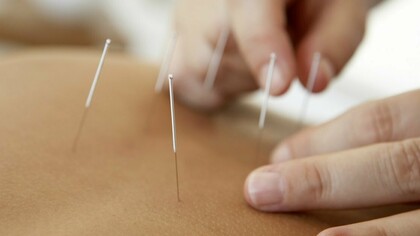 Acupuncture