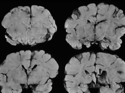 Se han identificado varios coronavirus mediante técnicas serológicas en una amplia variedad de patologías neurológicas, como la enfermedad de Parkinson, la esclerosis lateral amiotrófica, la esclerosis múltiple y la neuritis óptica