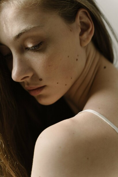 A close-up of multiple skin spots and moles, reflecting the value of recognizing changes that may warrant medical attention