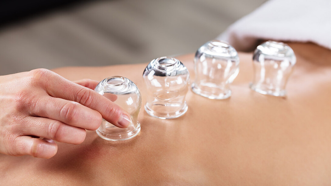 Cupping therapy