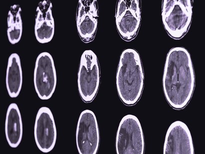 Por lo general, los pacientes con COVID-19 presentan más de un vaso bloqueado con un trombo