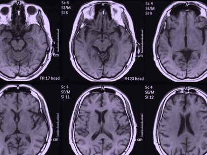 Las series de casos son útiles para levantar la sospecha de una asociación o factor de riesgo novedoso o único, pero deben validarse en estudios metodológicamente sólidos