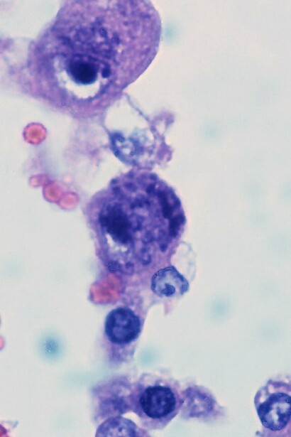 Infección por cetomegalovirus