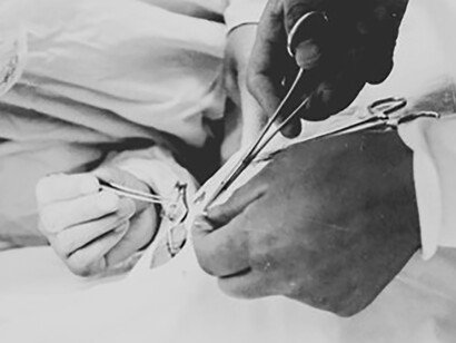 Acupuncture anesthesia is not a new concept in Chinese medicine