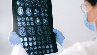 Um médico segurando um resultado de ressonância magnética do cérebro