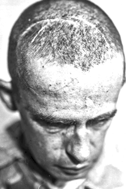 Uno de los pacientes del doctor Cushing