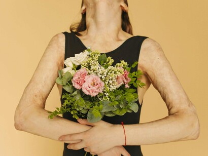 A woman with burn scars embracing a bouquet of blossoms, evoking hope, healing, and self-acceptance