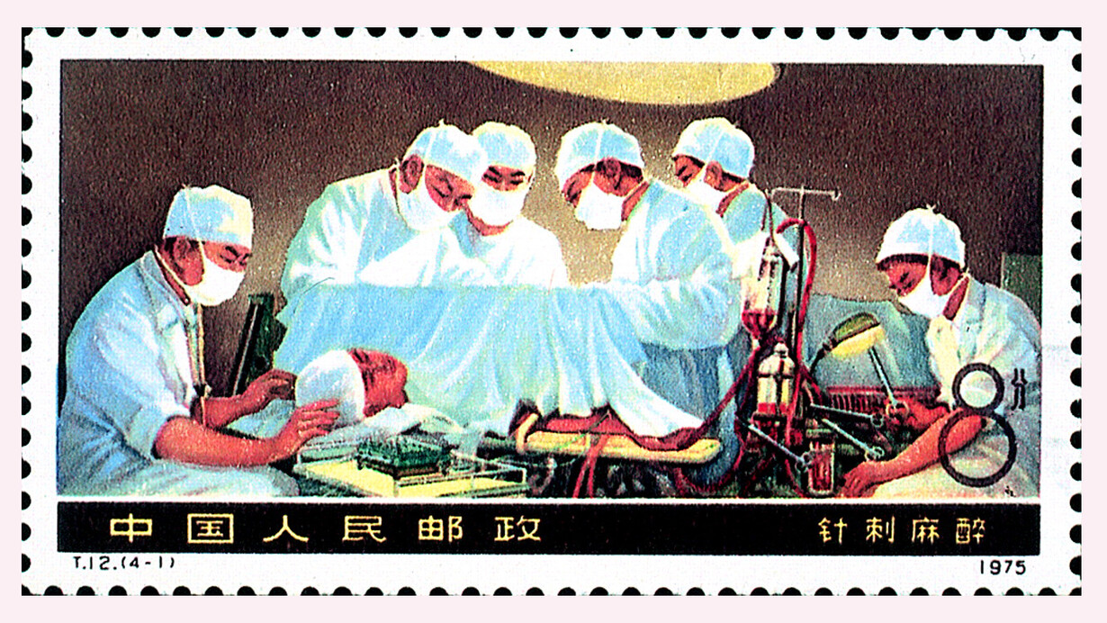 The 1975 Chinese postage stamp shows an open heart surgery under acupuncture anesthesia